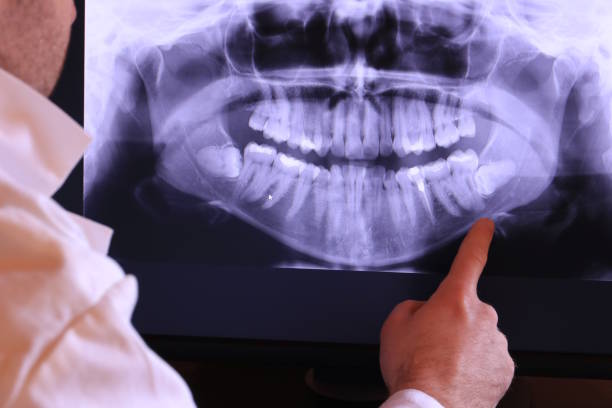 Best Emergency Wisdom Tooth Extraction in Andusia, AL