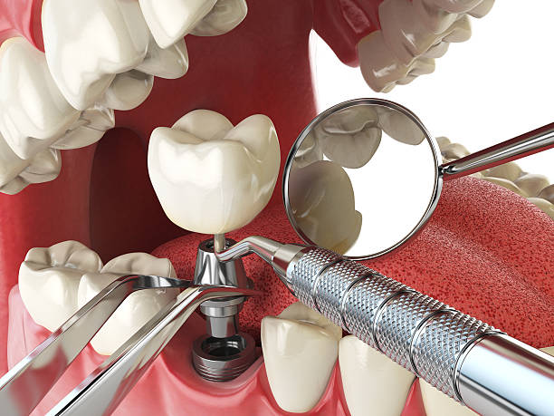 Best Emergency Root Canal Therapy in Andusia, AL